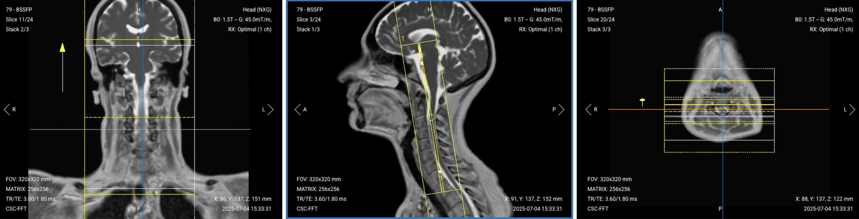 Correct Planning of Coronal T2 TSE