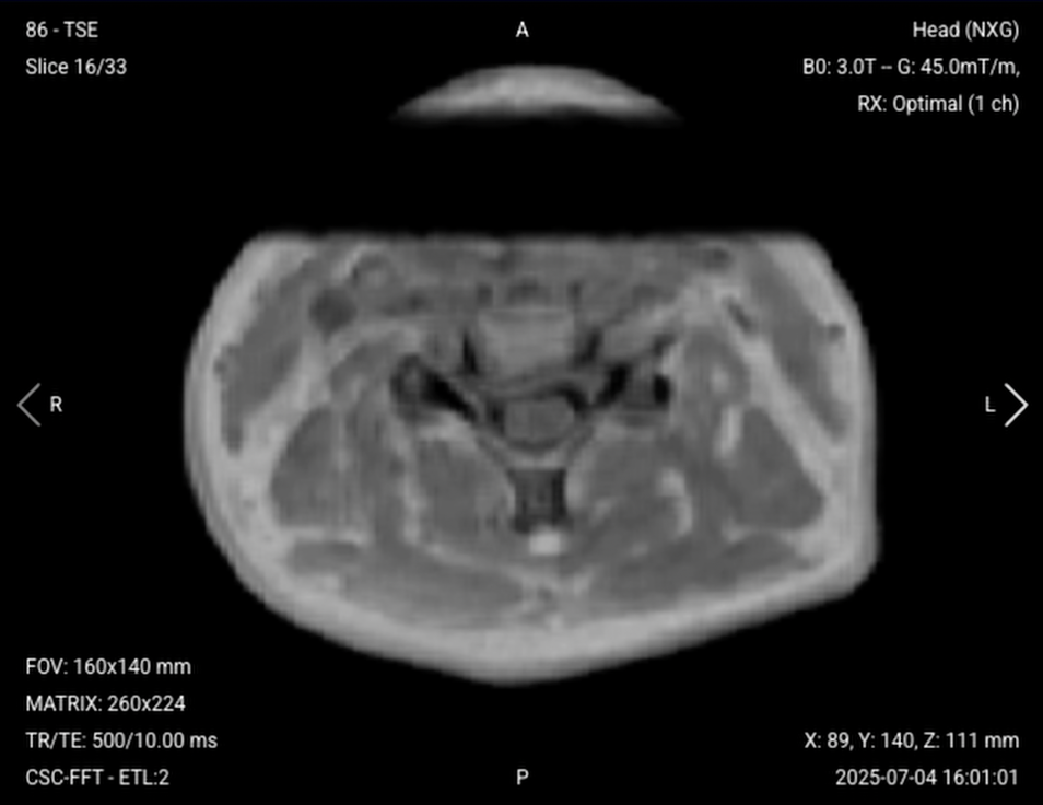 Axial T1 TSE of the Cervical Spine – Correct Image Example