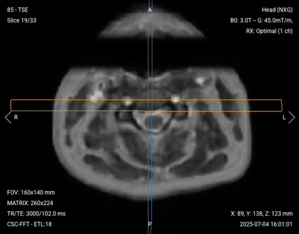 Axial T2 TSE of the Cervical Spine – Correct Image Example