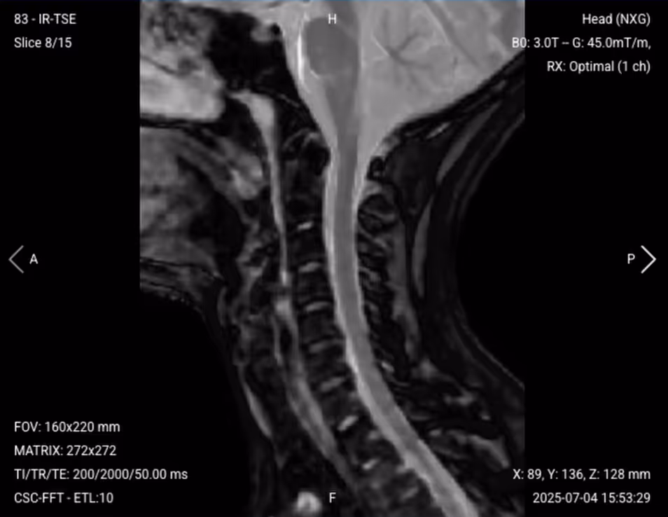Sagittal STIR TSE of the Cervical Spine – Correct Image Example