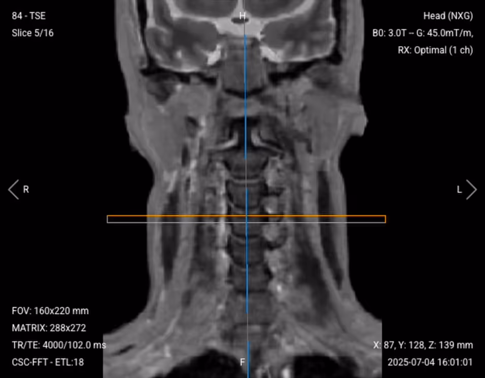 Coronal T2 TSE of the Cervical Spine – Correct Image Exampl