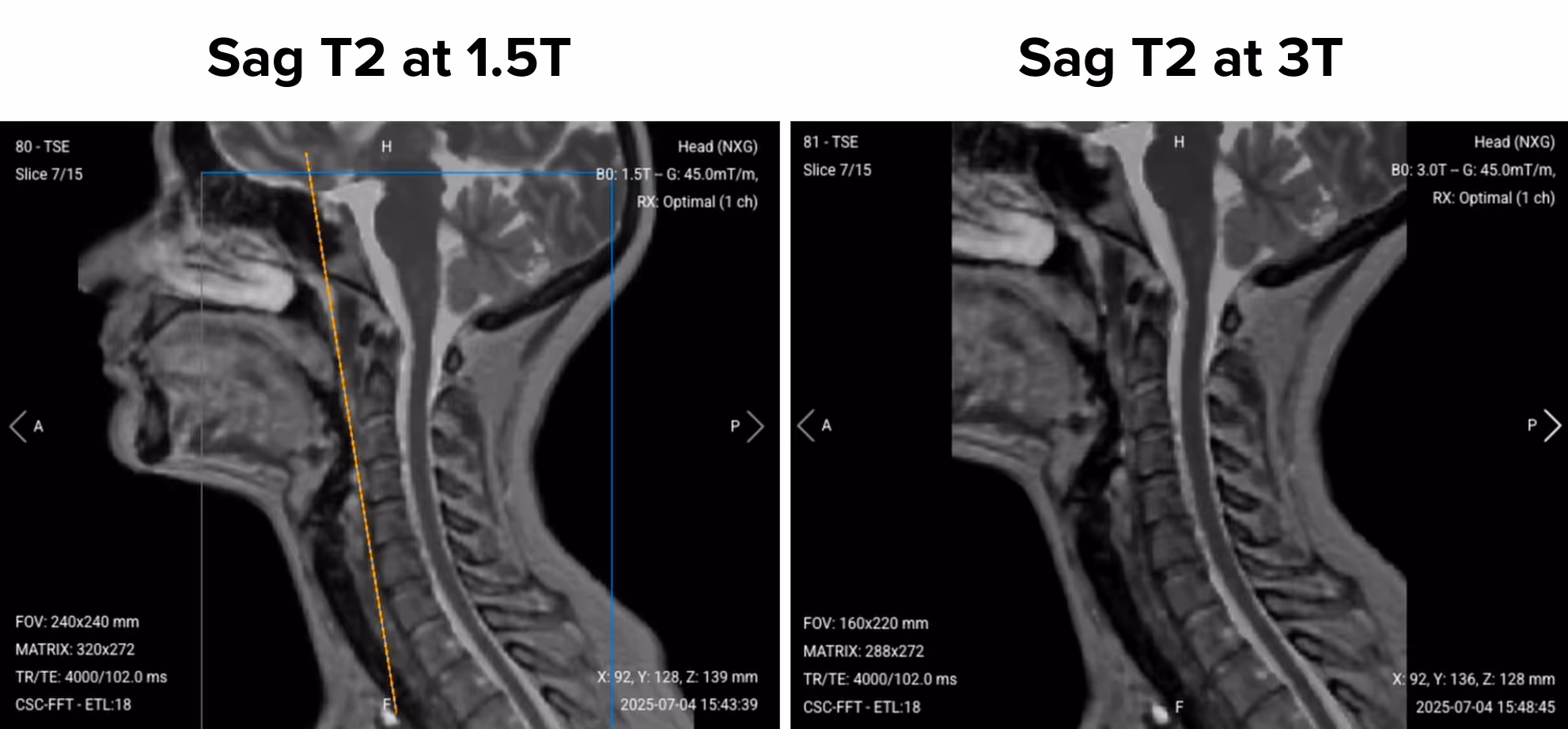 Sagittal T2 MRI comparison of the cervical spine at 1.5 Tesla and 3 Tesla. The left image (1.5T) shows lower resolution with more noise, while the right image (3T) shows sharper detail and clearer visualization of spinal cord and discs.