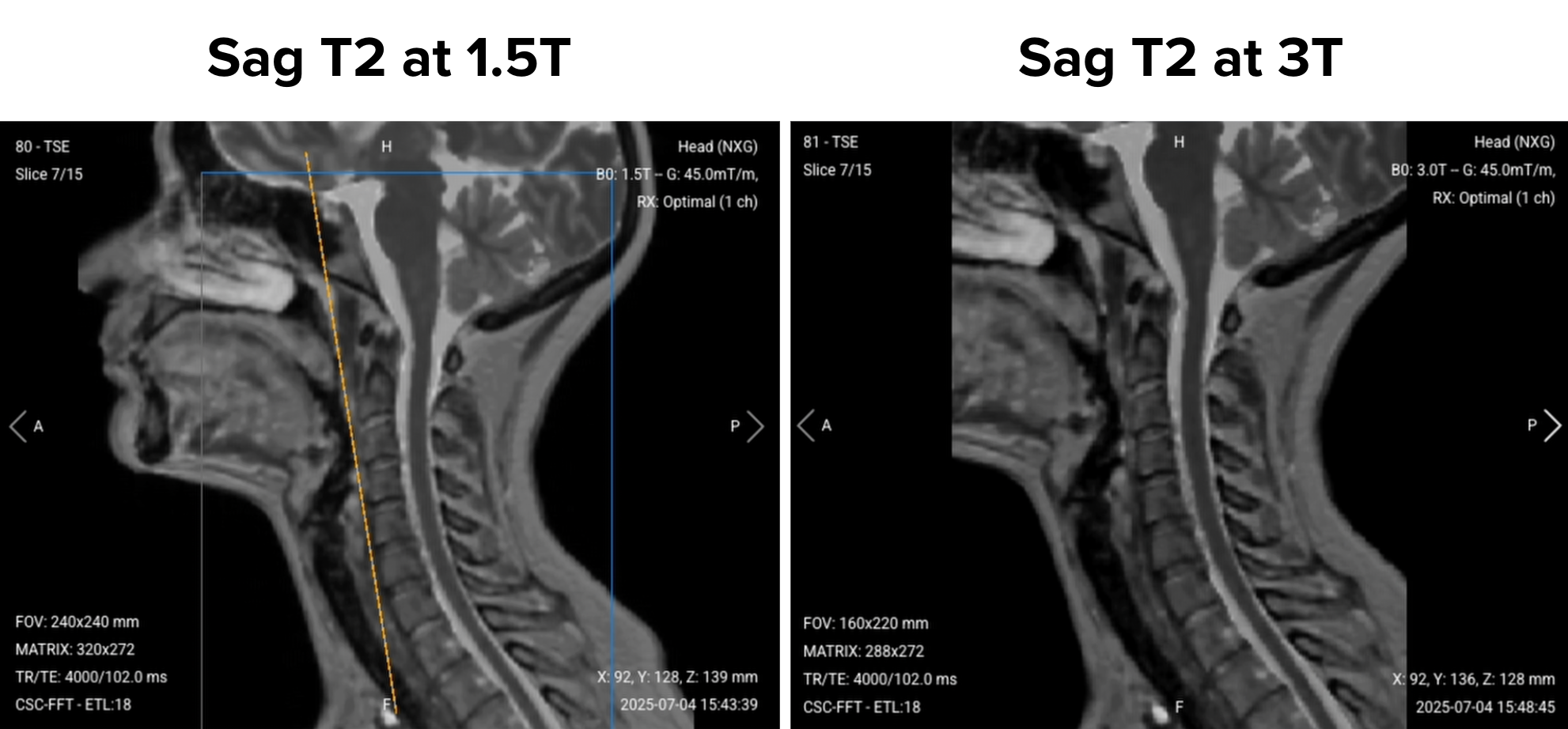 Sagittal T2 MRI comparison of the cervical spine at 1.5 Tesla and 3 Tesla. The left image (1.5 T) shows lower resolution with more noise, while the right image (3 T) shows sharper detail and clearer visualization of spinal cord and discs.