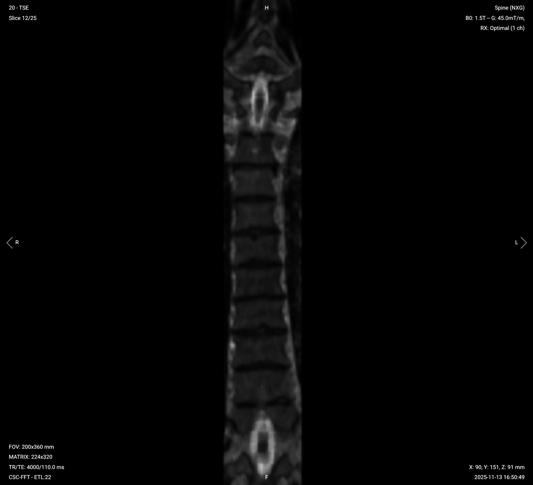 Coronal T2 TSE of Thoracic Spine – Correct Image Example: