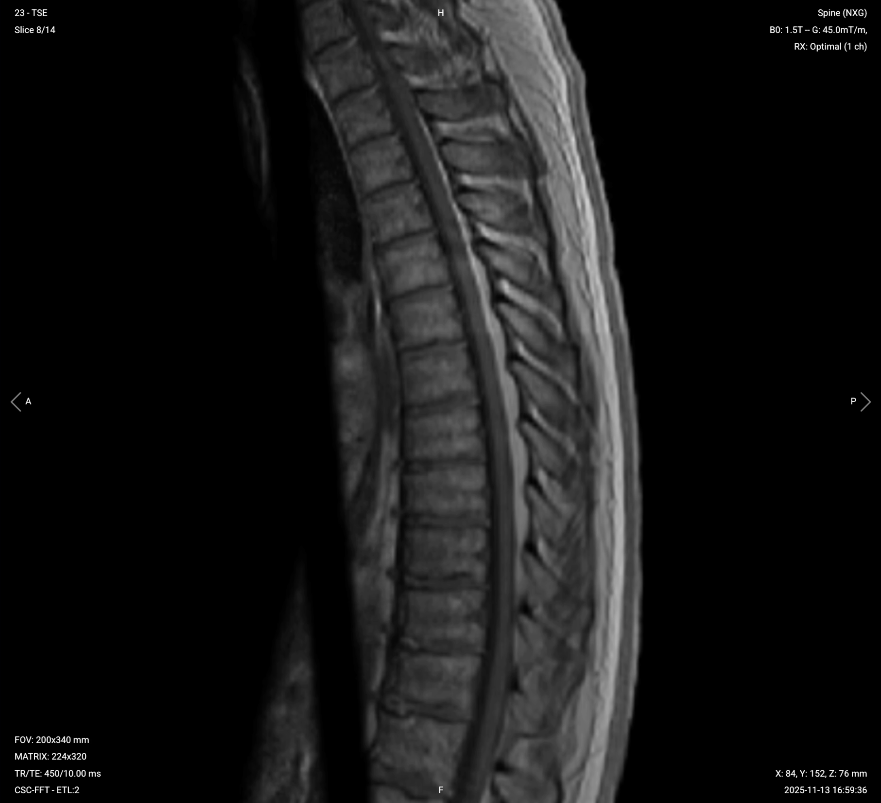 Sagittal T1 TSE of Thoracic Spine – Correct Image Example