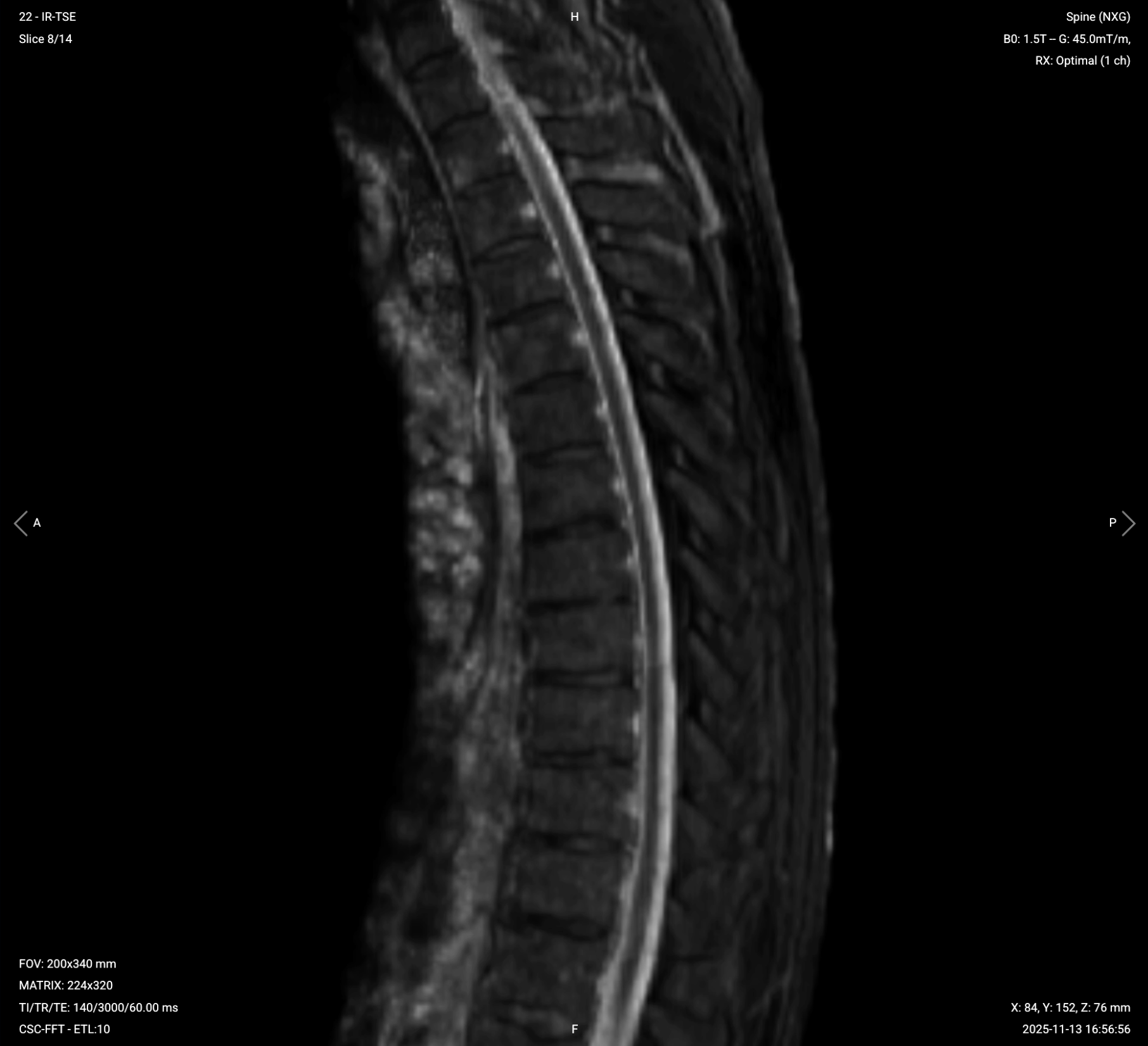 Sagittal STIR TSE of Thoracic Spine – Correct Image Example