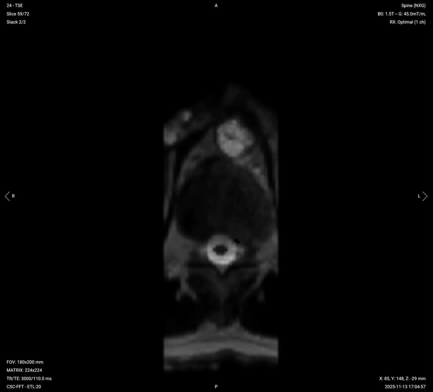 Axial T2 TSE of Thoracic Spine – Correct Image Example