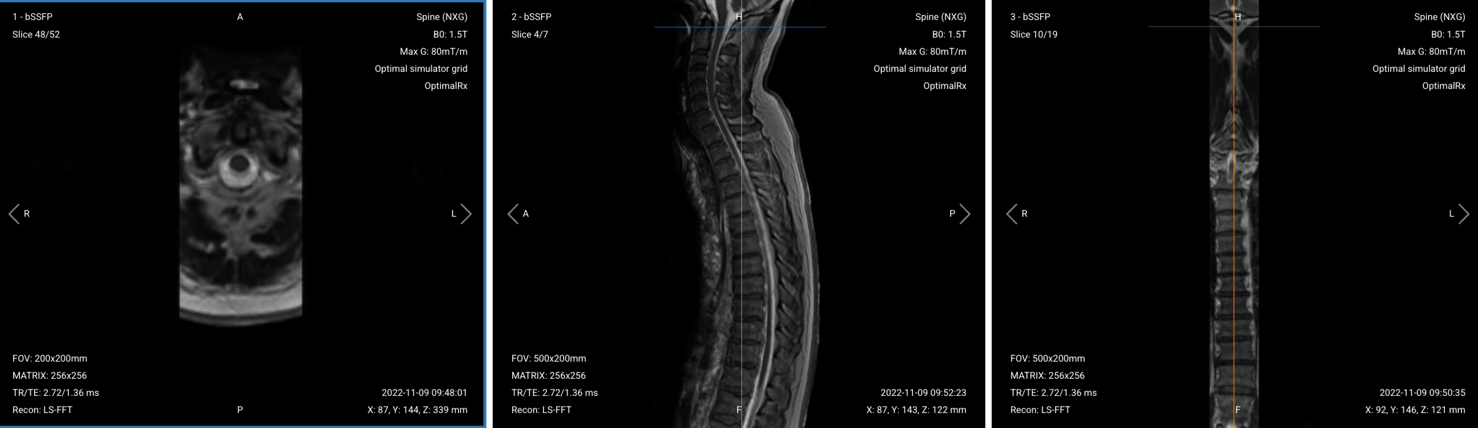 Correct Setup of Localizer Images for Thoracic Spine MRI, showing (from left to right) axial, sagittal and coronal localizers