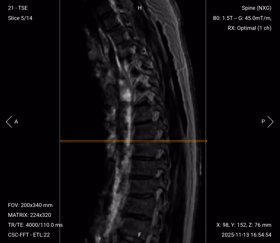 Sagittal T2 TSE of Thoracic Spine – Correct Image Example