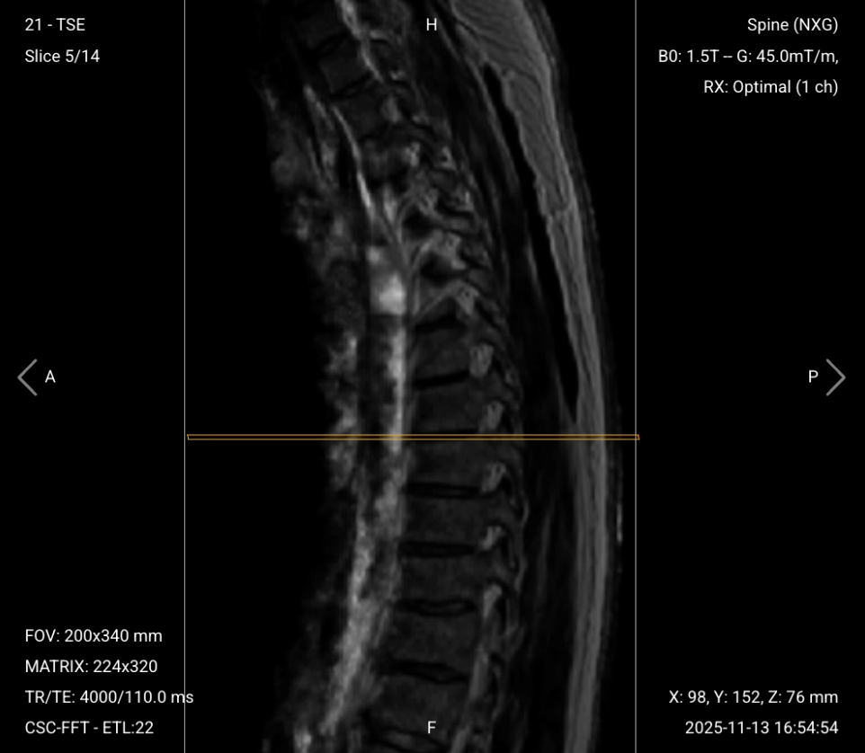 Sagittal T2 TSE of Thoracic Spine – Correct Image Example