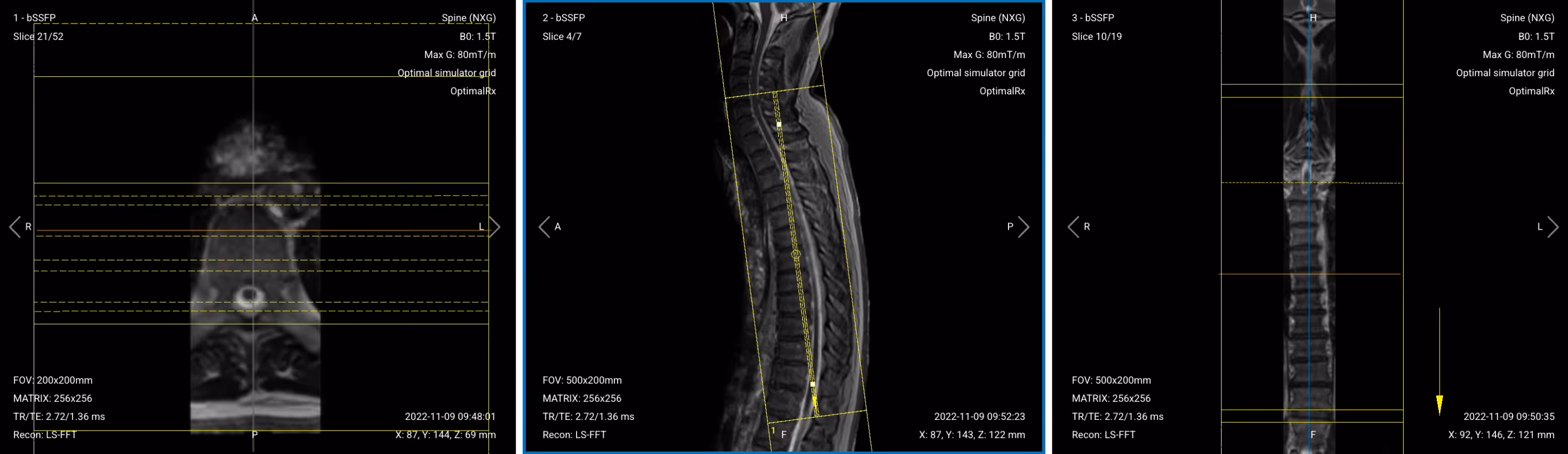 Correct planning of Coronal T2 TSE for thoracic spine MRI