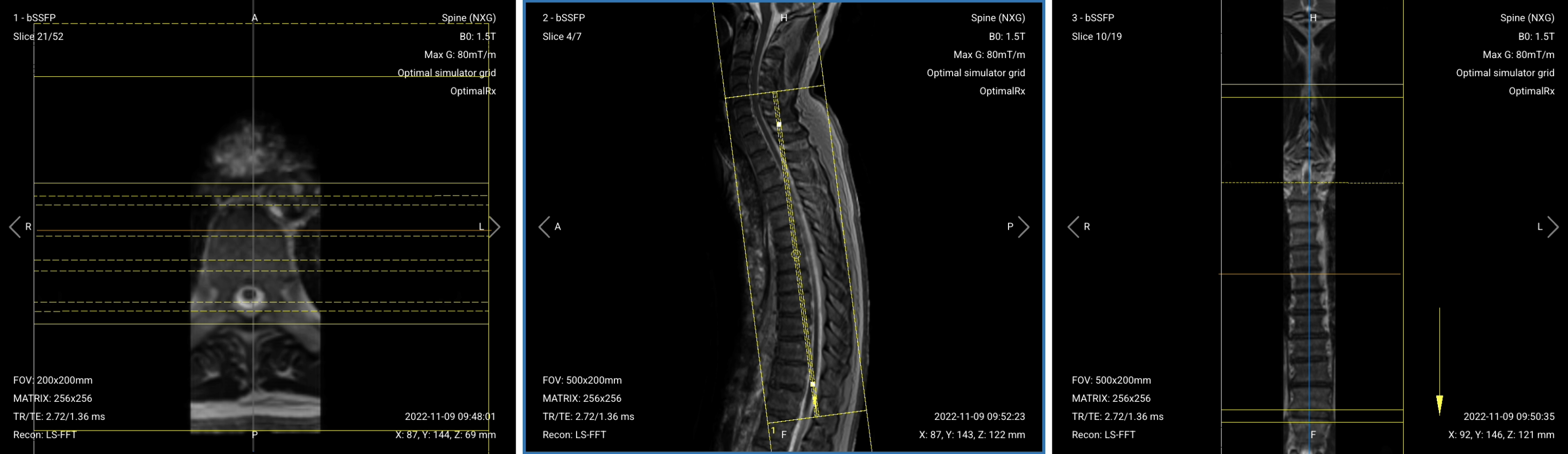 Correct planning of Coronal T2 TSE for thoracic spine MRI