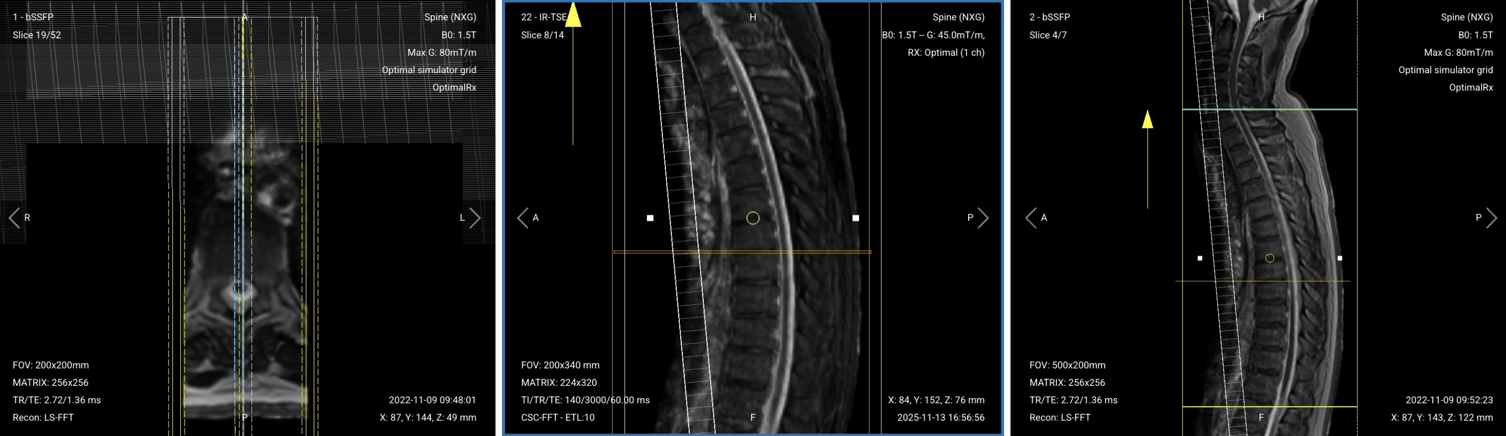 Correct planning of Sagittal T1 TSE for thoracic spine MRI with saturation band