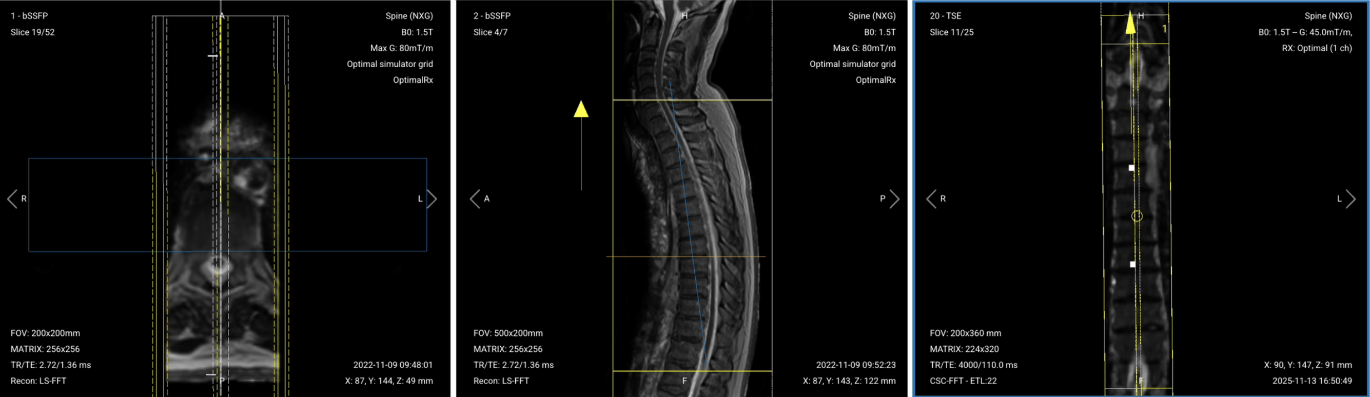 Correct planning of Sagittal T2 TSE for thoracic spine MRI