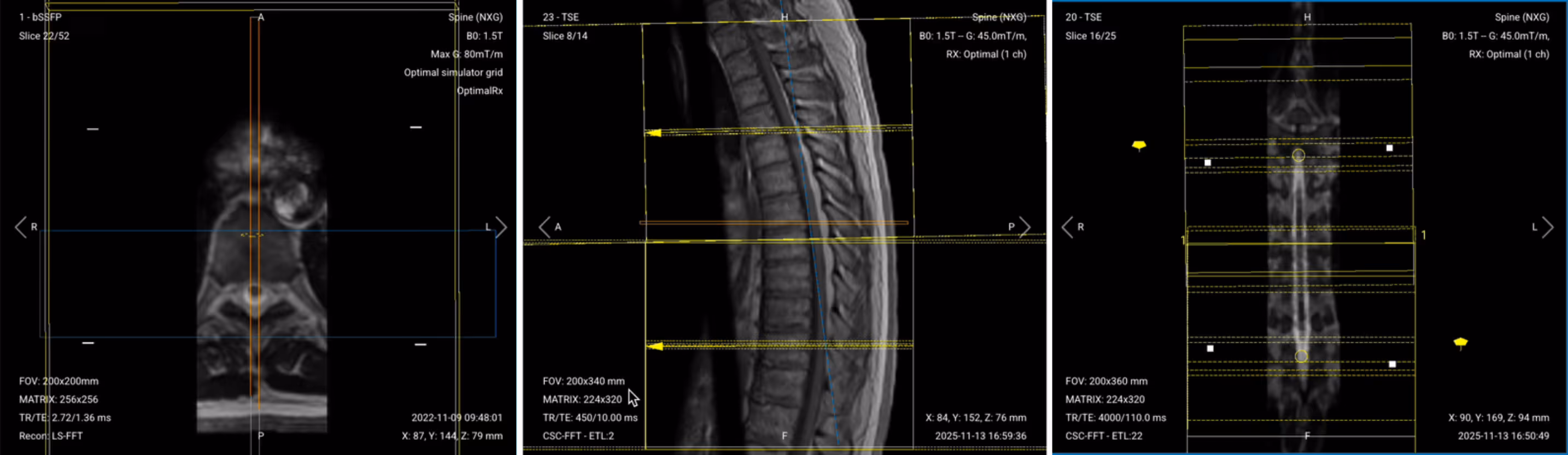 Correct planning of axial T2 and T1 TSE for thoracic spine MRI