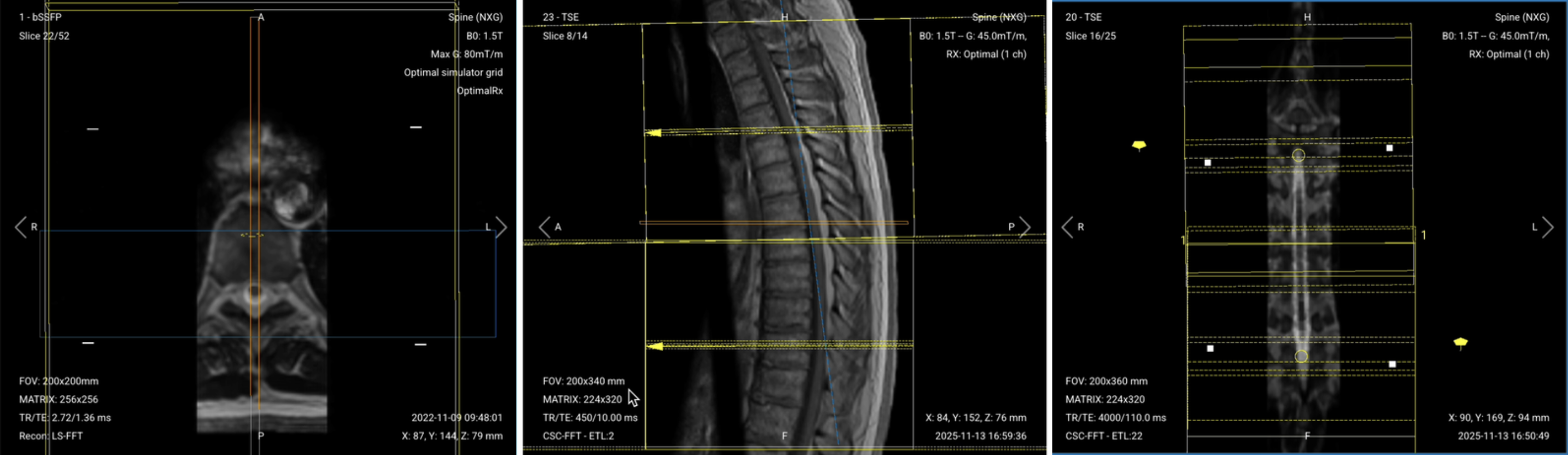 Correct planning of axial T2 and T1 TSE for thoracic spine MRI