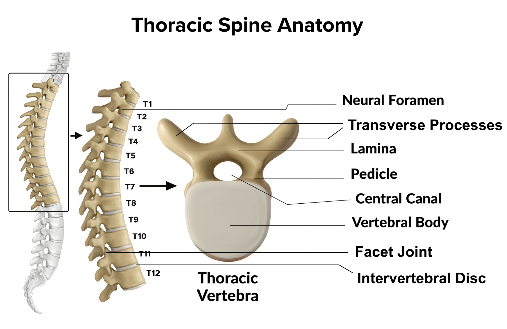 Illustration of thoracic spine anatomy. The left side shows the full thoracic spine from T1 to T12 highlighted within the spine. The right side shows a labeled diagram of a single thoracic vertebra, with arrows identifying the neural foramen, lamina, pedicle, central canal, vertebral body, facet joint, and intervertebral disc.