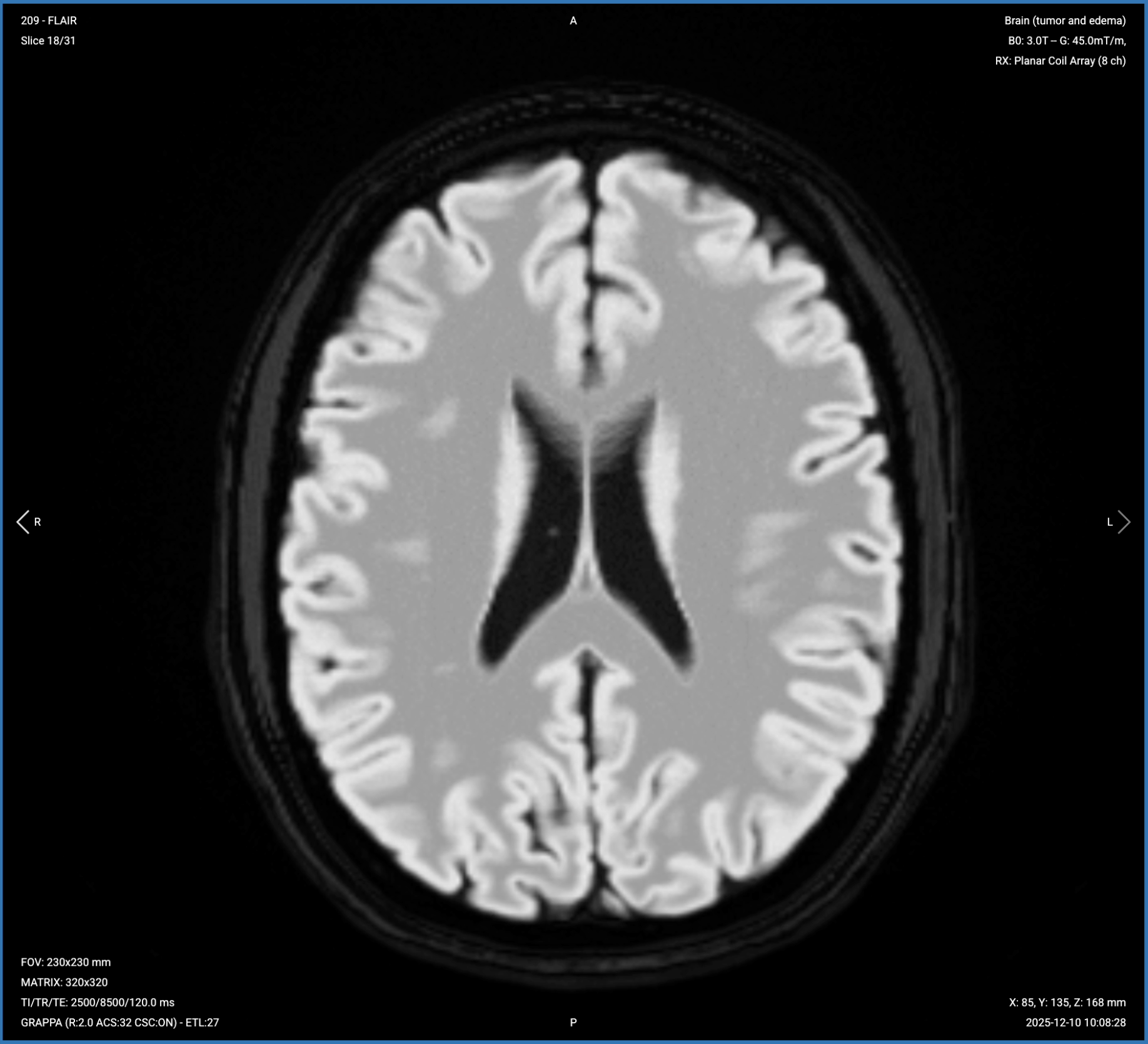 Axial T2 FLAIR Fat-Sat of the Brain – Correct Image Example