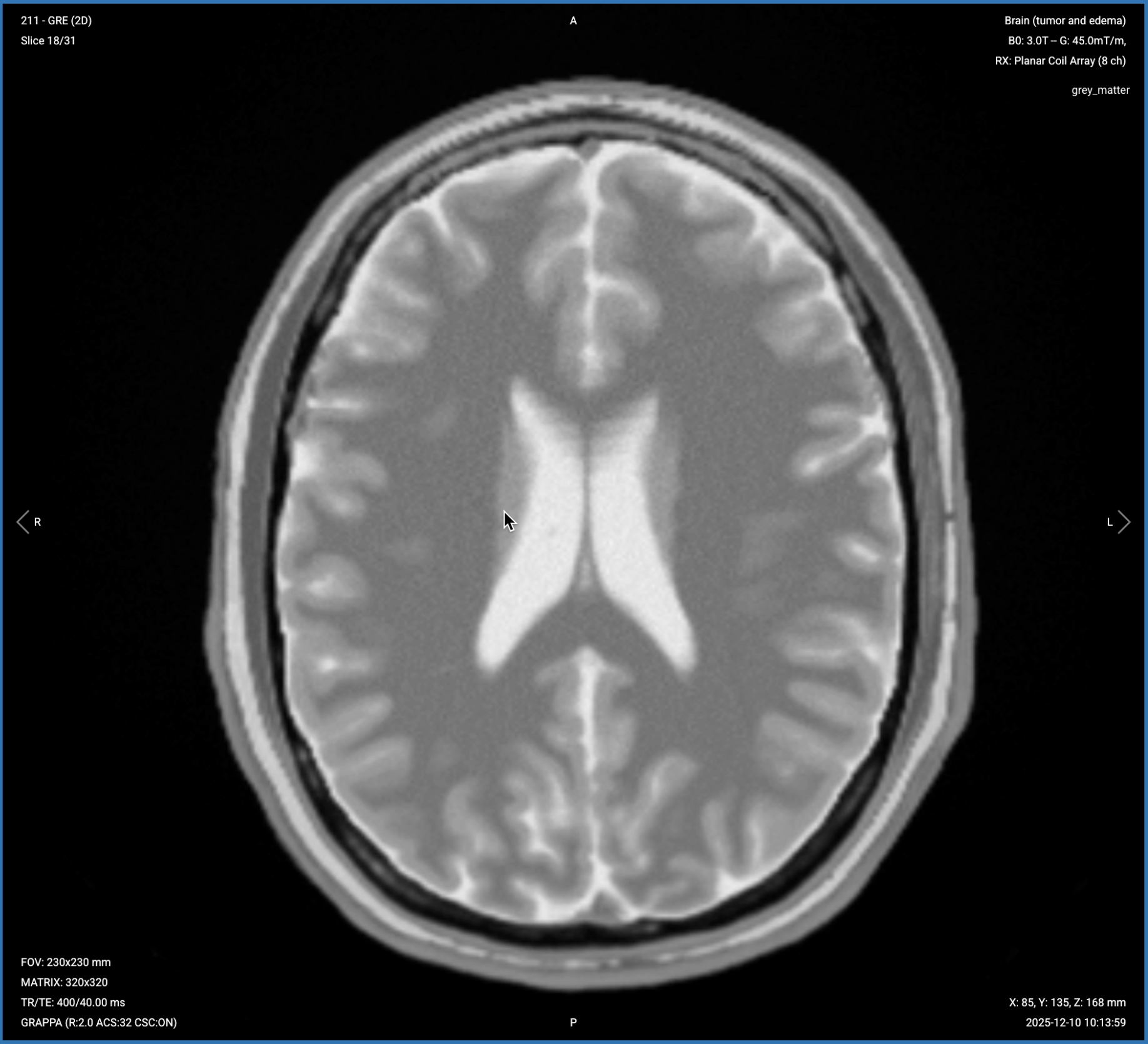 Axial T2* Gradient Echo of the Brain – Correct Image Example
