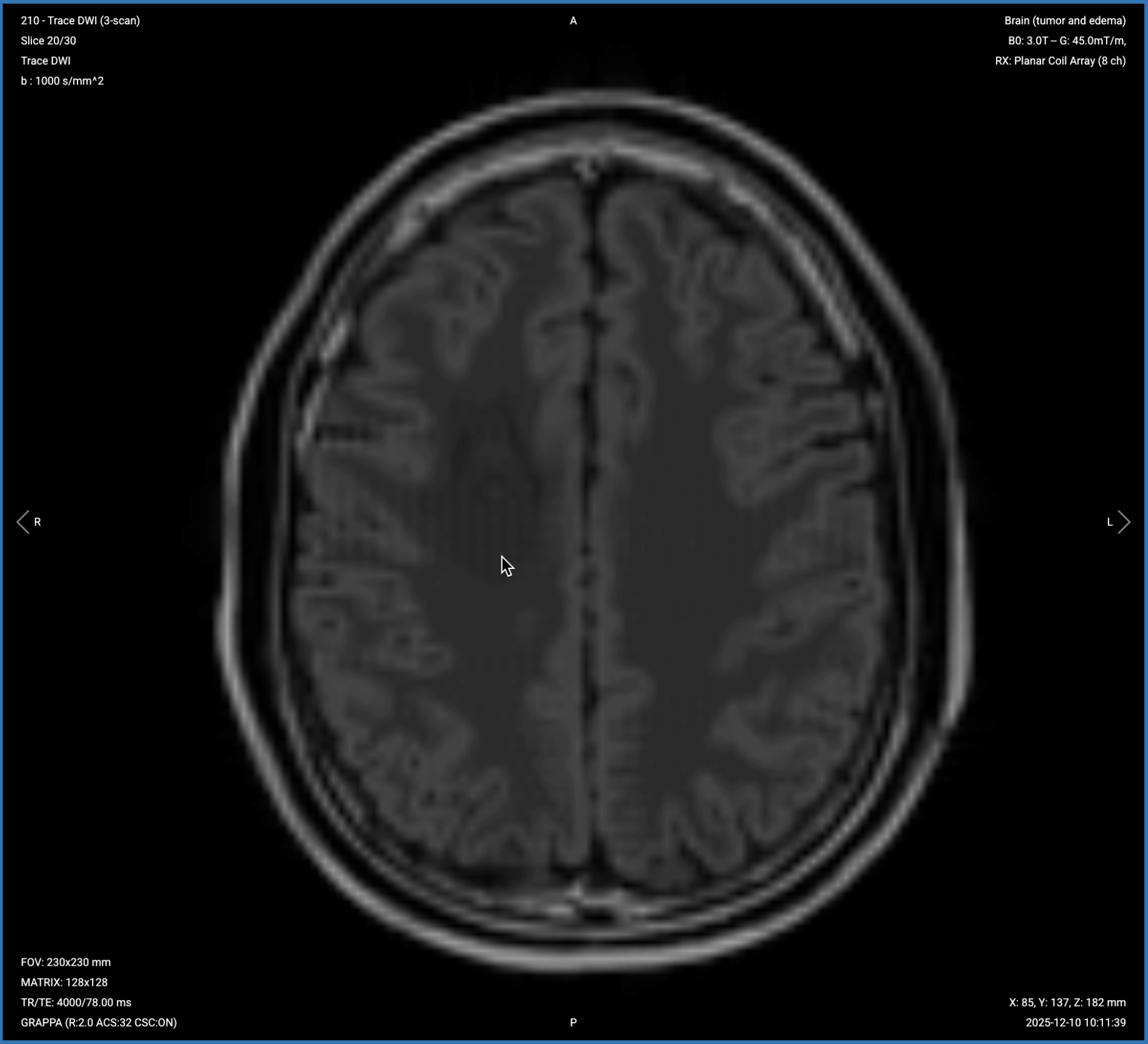 Axial DWI of the brain, True Diffusion Image (b=1000) – correct image example