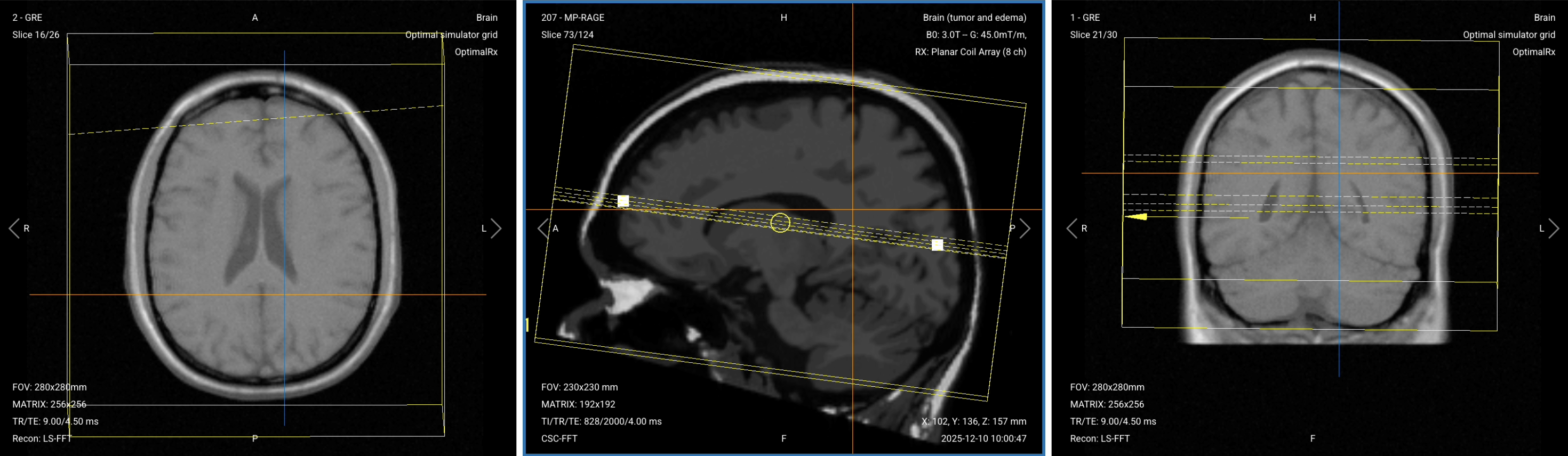 Correct Planning Axial Diffusion-Weighted Imaging (DWI) with ADC Map