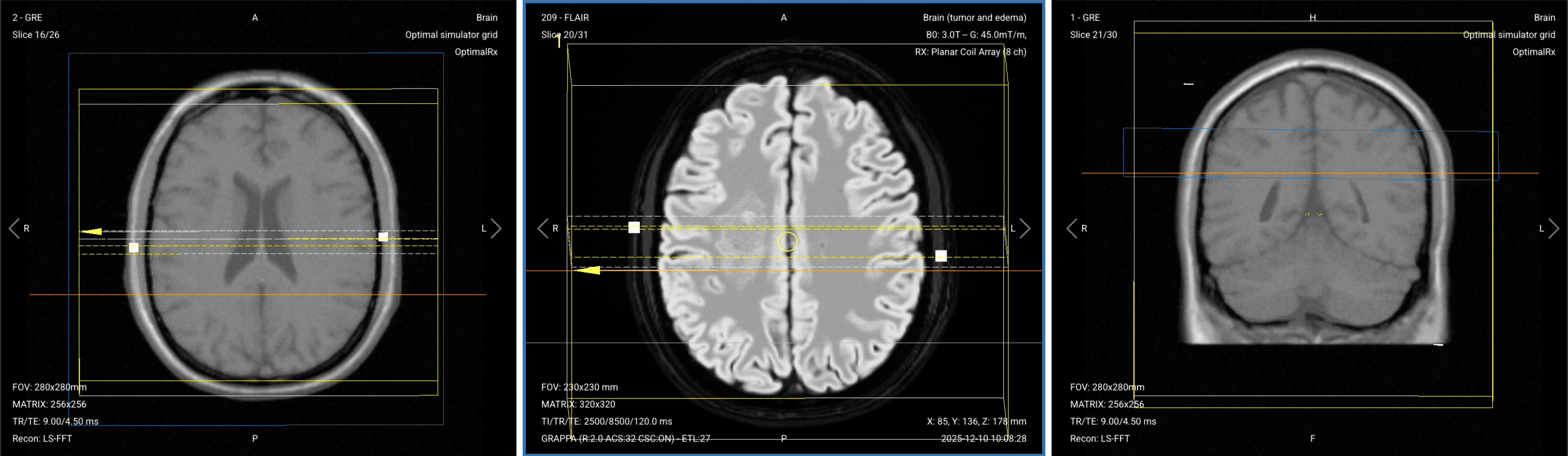 Planning Coronal T1 TSE with Fat Suppression (Post-Contrast) – Correct Planning