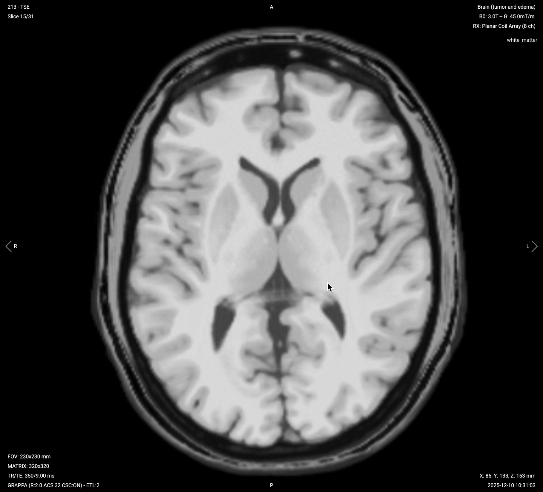 Axial T1 with Fat Suppression (Post-Contrast) – Correct Image Example