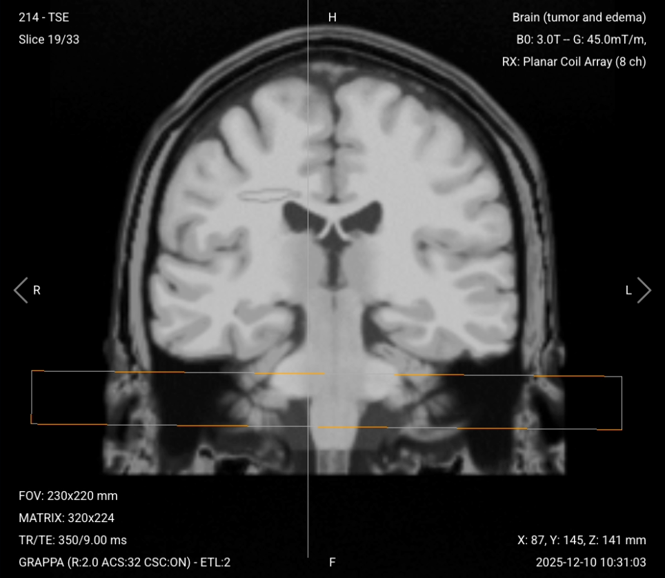 Coronal T1 with Fat Suppression (Post-Contrast) – Correct Image Example