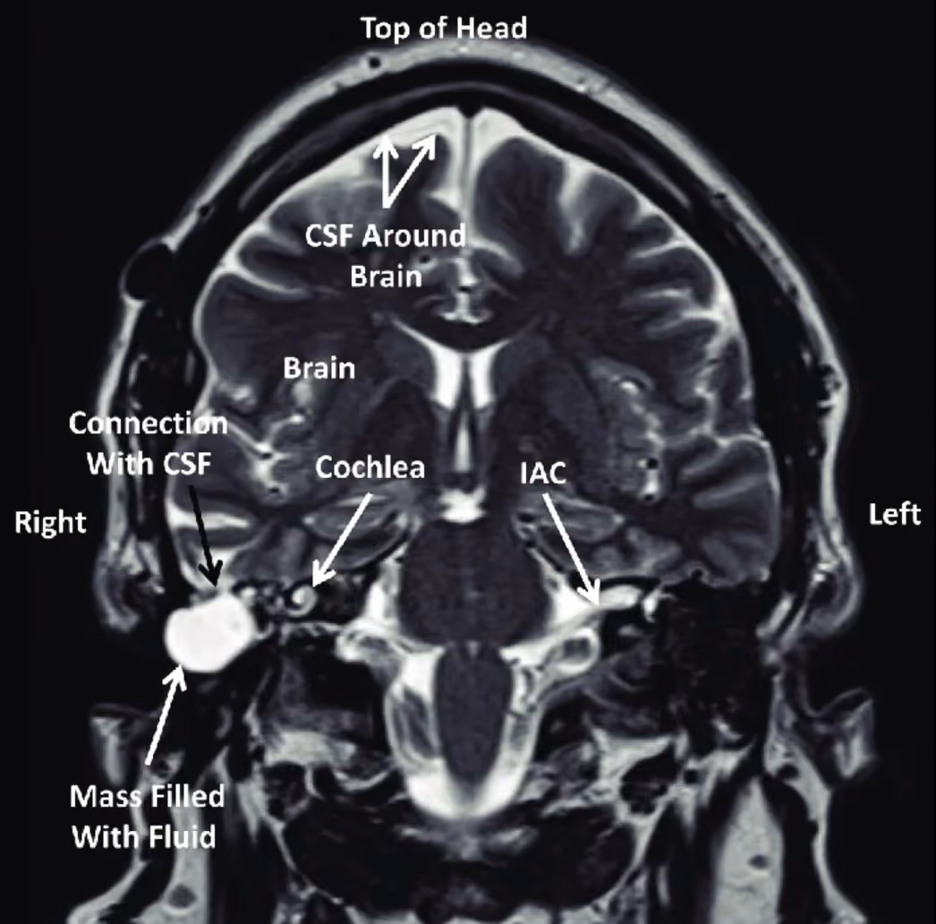 Anatomy of the internal auditory canal (IAC/IAM) in coronal view, showing the IAC, cochlea, CSF around the brain, connection with CSF, and a mass filled with fluid