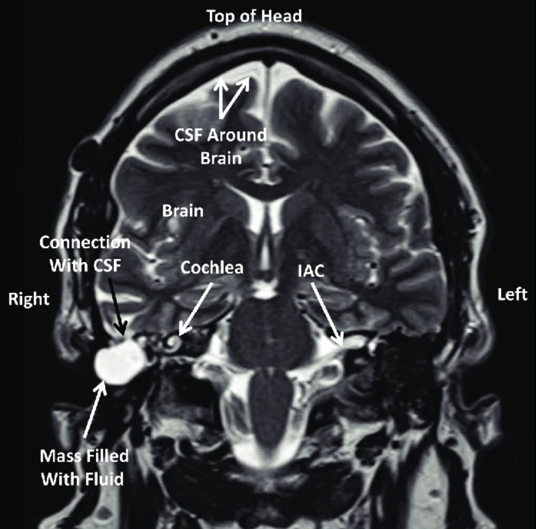 Anatomy of the internal auditory canal (IAC/IAM) in coronal view, showing the IAC, cochlea, CSF around the brain, connection with CSF, and a mass filled with fluid