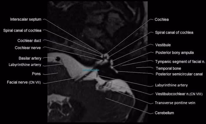 Anatomy of the internal auditory canal (IAC/IAM) in axial view, showing the IAC, cochlea, labyrinthine arteries, pons, vestibule, cranial nerves (CN VII–VIII), and cerebellum