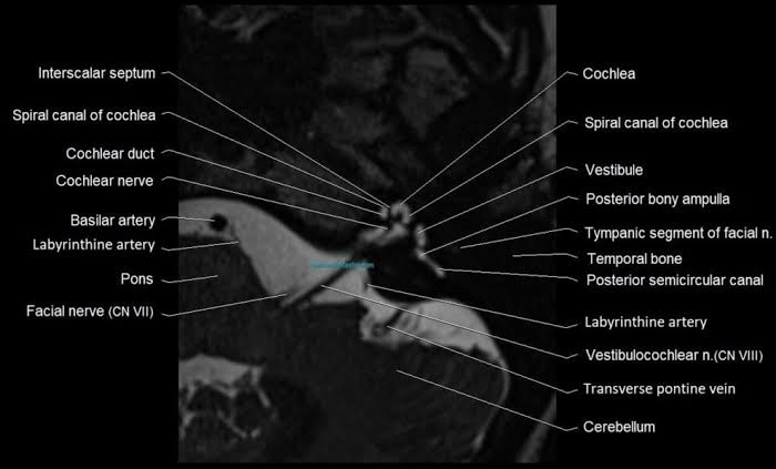Anatomy of the internal auditory canal (IAC/IAM) in axial view, showing the IAC, cochlea, labyrinthine arteries, pons, vestibule, cranial nerves (CN VII–VIII), and cerebellum