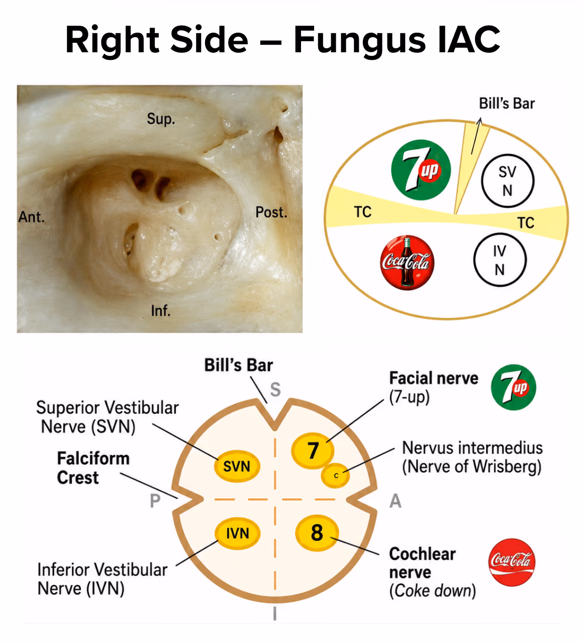 Cross-section of the internal auditory canal fundus showing the four nerve quadrants divided by the transverse crest and Bill’s bar