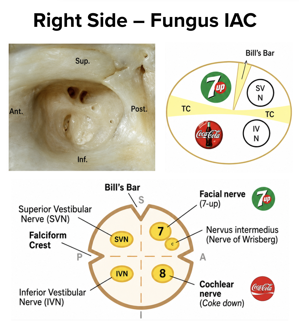 Cross-section of the internal auditory canal fundus showing the four nerve quadrants divided by the transverse crest and Bill’s bar