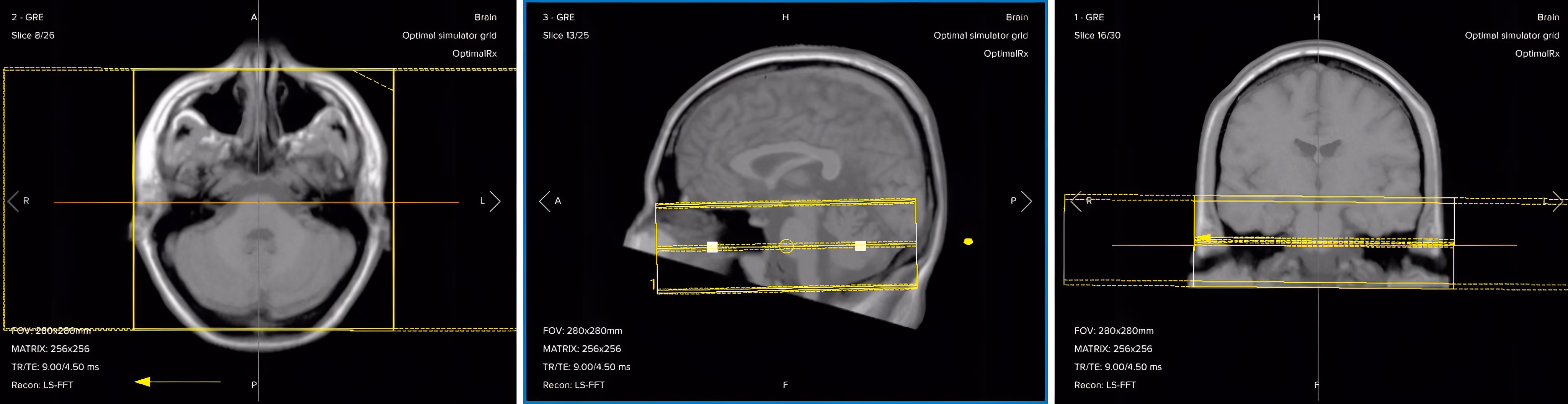 Correct planning of axial T2 TSE for an IAC/IAM MRI protocol
