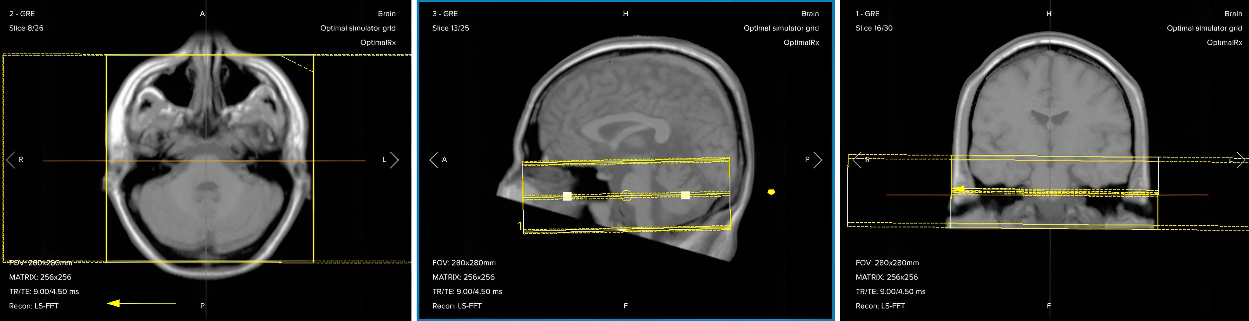 Correct planning of axial T2 TSE for an IAC/IAM MRI protocol