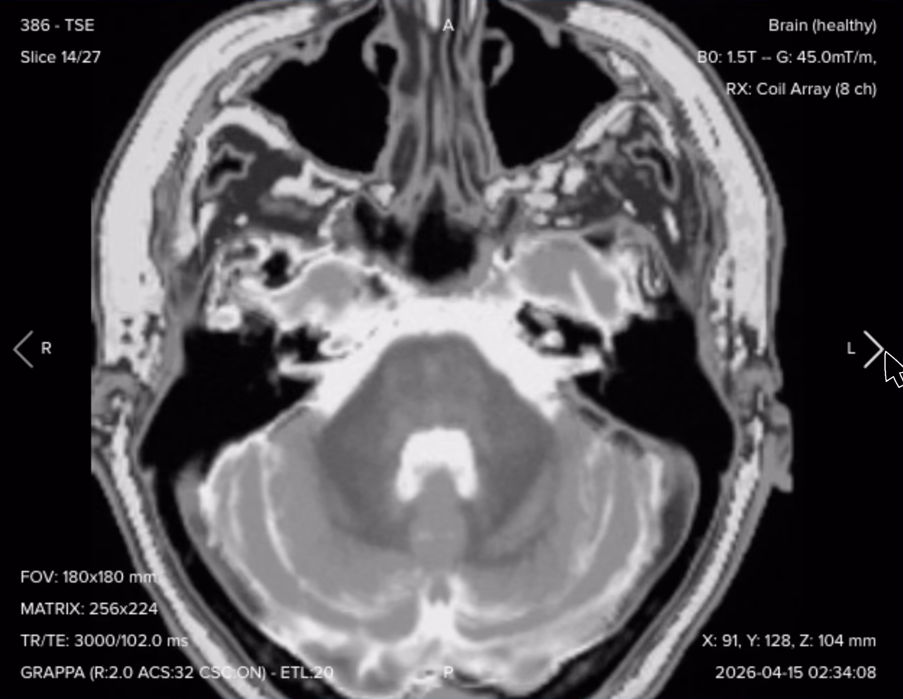 Axial T2 TSE of the IAC, showing cranial nerves against bright cerebrospinal fluid