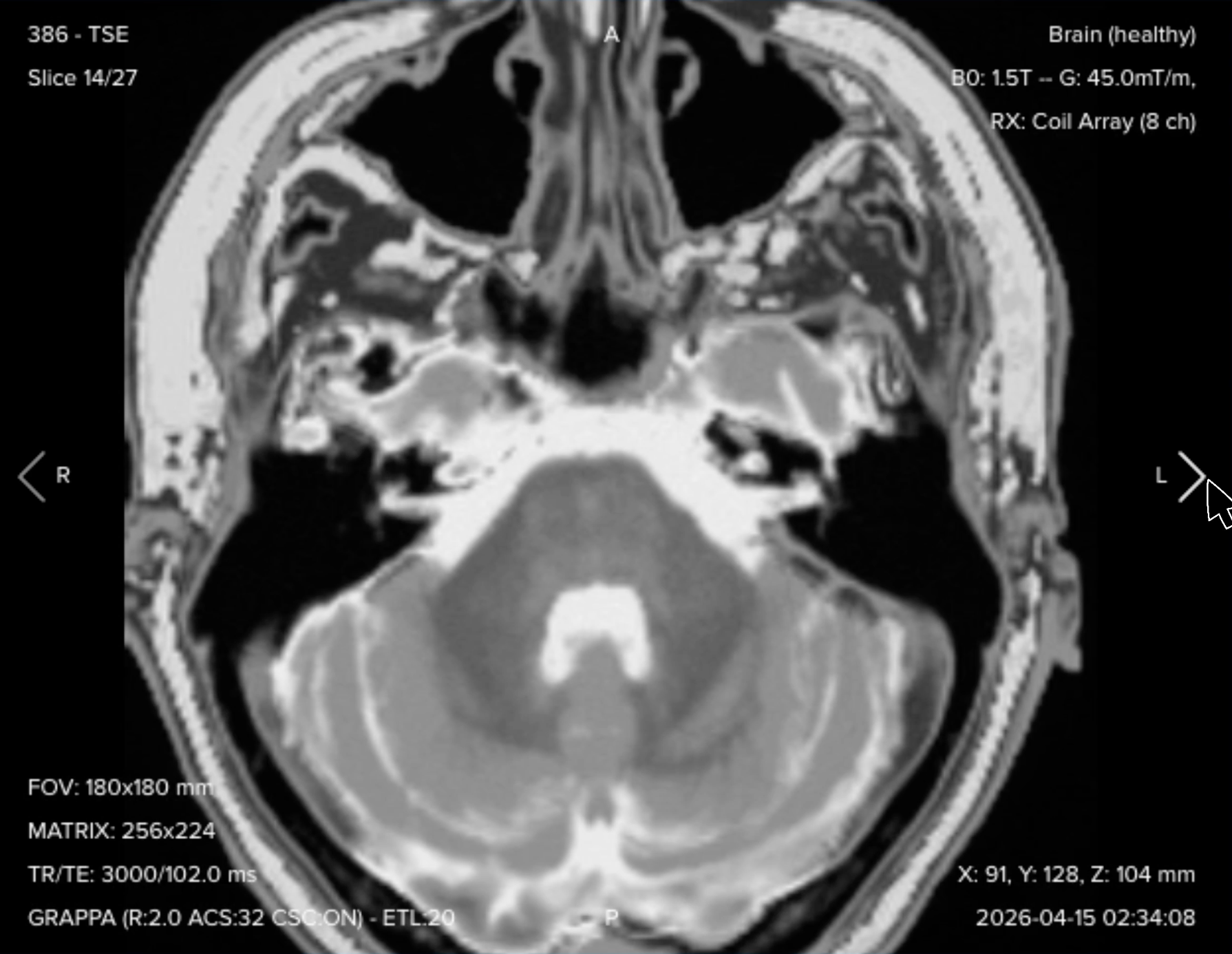 Axial T2 TSE of the IAC, showing cranial nerves against bright cerebrospinal fluid