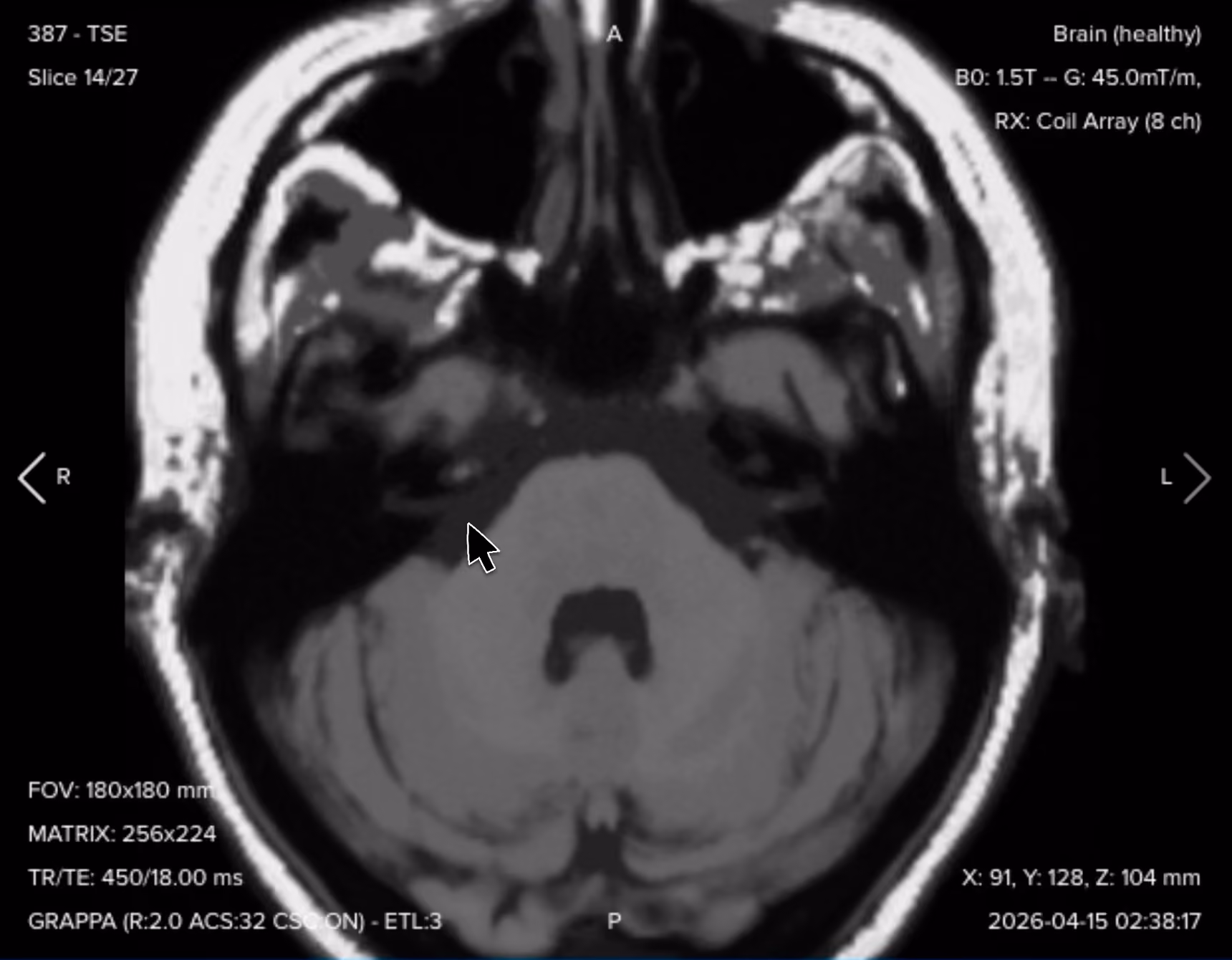 Axial T1 TSE of the internal auditory canal, showing baseline anatomy before contrast