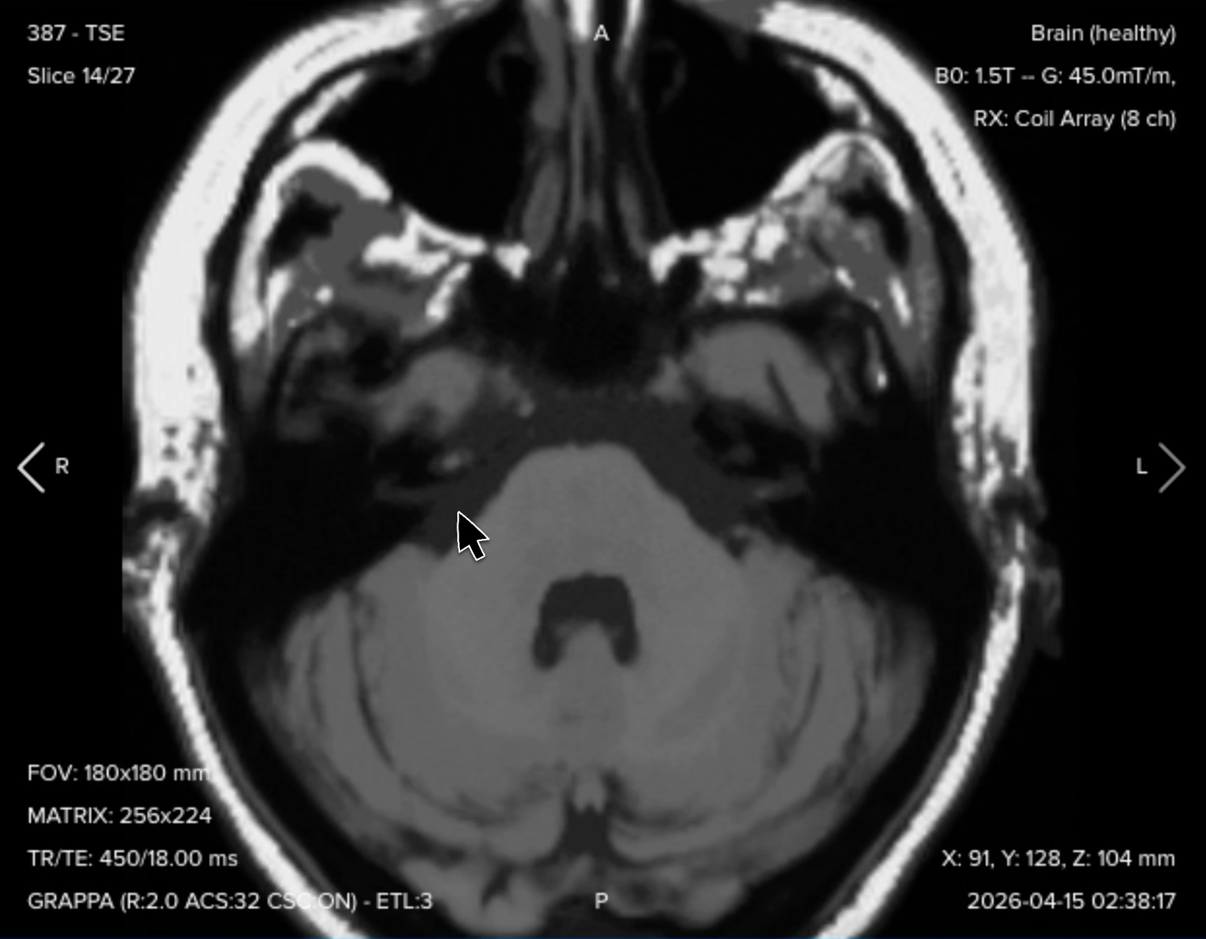 Axial T1 TSE of the internal auditory canal, showing baseline anatomy before contrast
