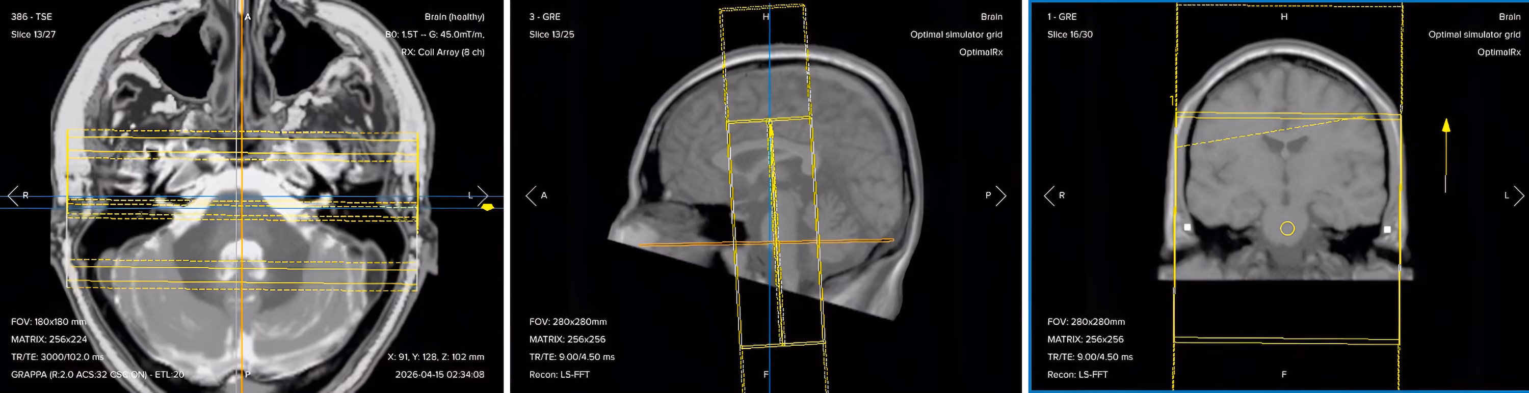 Correct planning of coronal T2 TSE for an IAC/IAM MRI protocol
