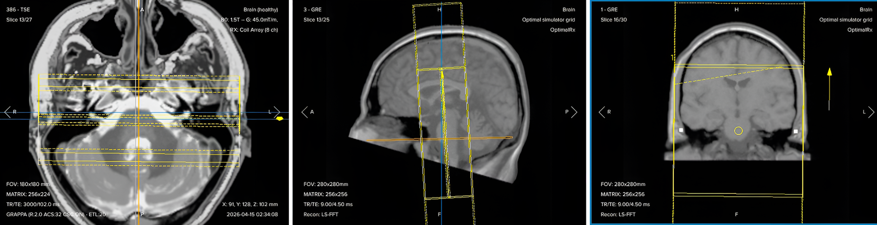 Correct planning of coronal T2 TSE for an IAC/IAM MRI protocol
