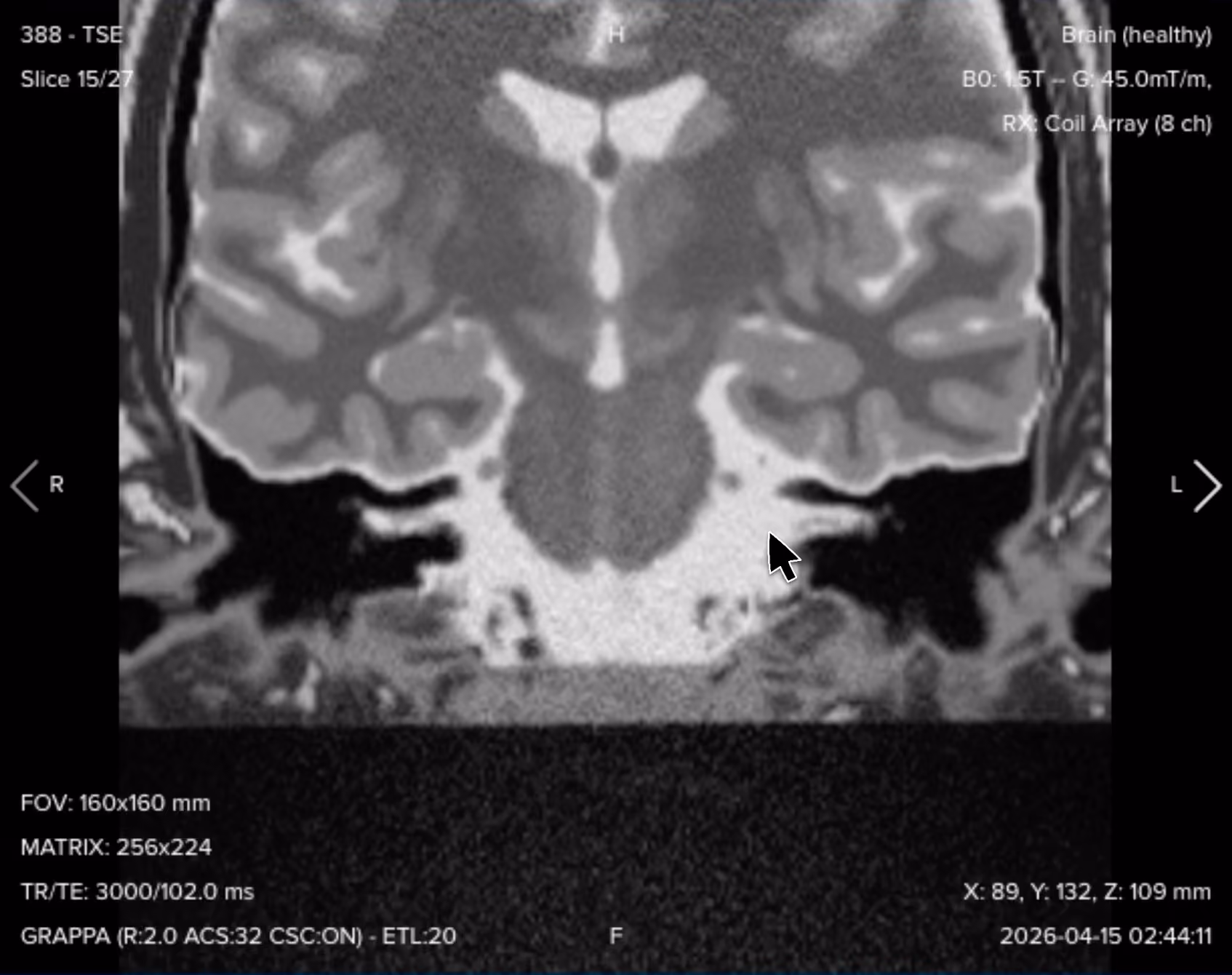 Coronal T2 TSE of the internal auditory canal and cerebellopontine angle