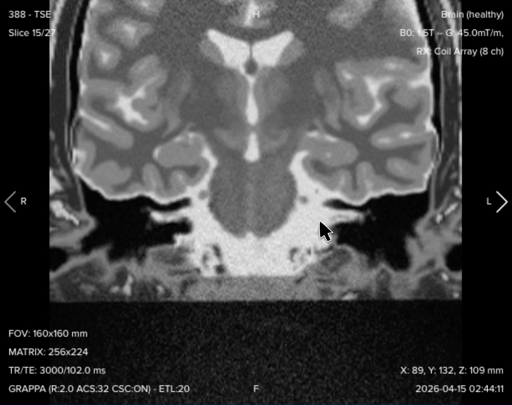 Coronal T2 TSE of the internal auditory canal and cerebellopontine angle