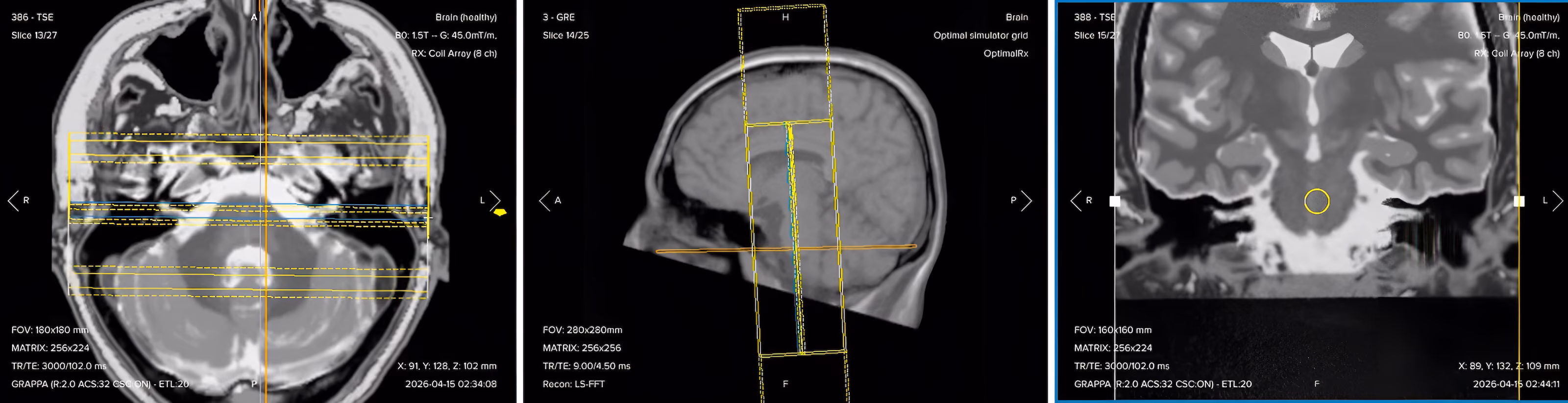 Correct planning of coronal T1 TSE for an IAC/IAM MRI protocol