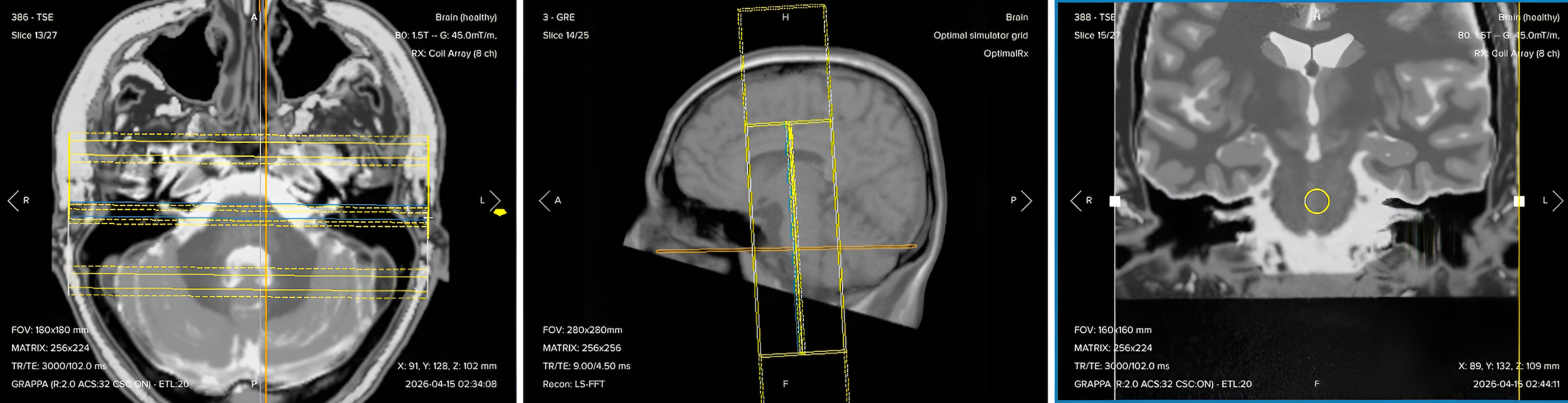 Correct planning of coronal T1 TSE for an IAC/IAM MRI protocol