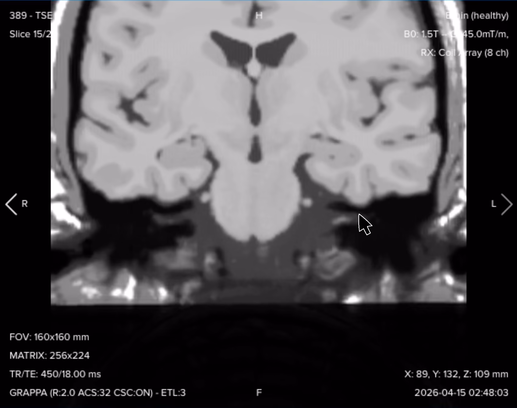 Coronal T1 TSE of the internal auditory canal, showing anatomical detail in a complementary plane