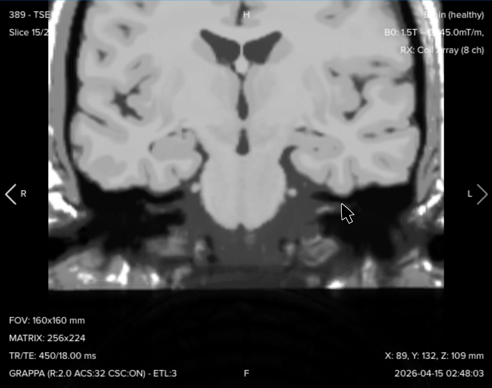 Coronal T1 TSE of the internal auditory canal, showing anatomical detail in a complementary plane
