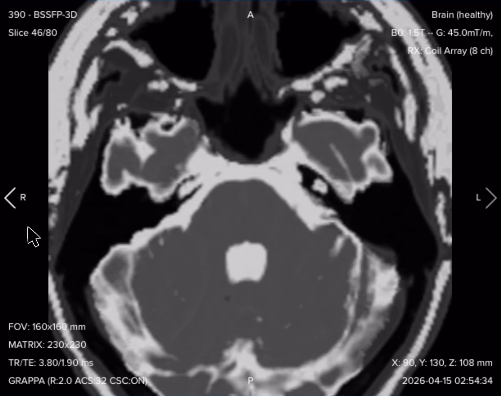 3D axial bSSFP (CISS/FIESTA) image showing cranial nerves VII and VIII as dark structures within bright cerebrospinal fluid
