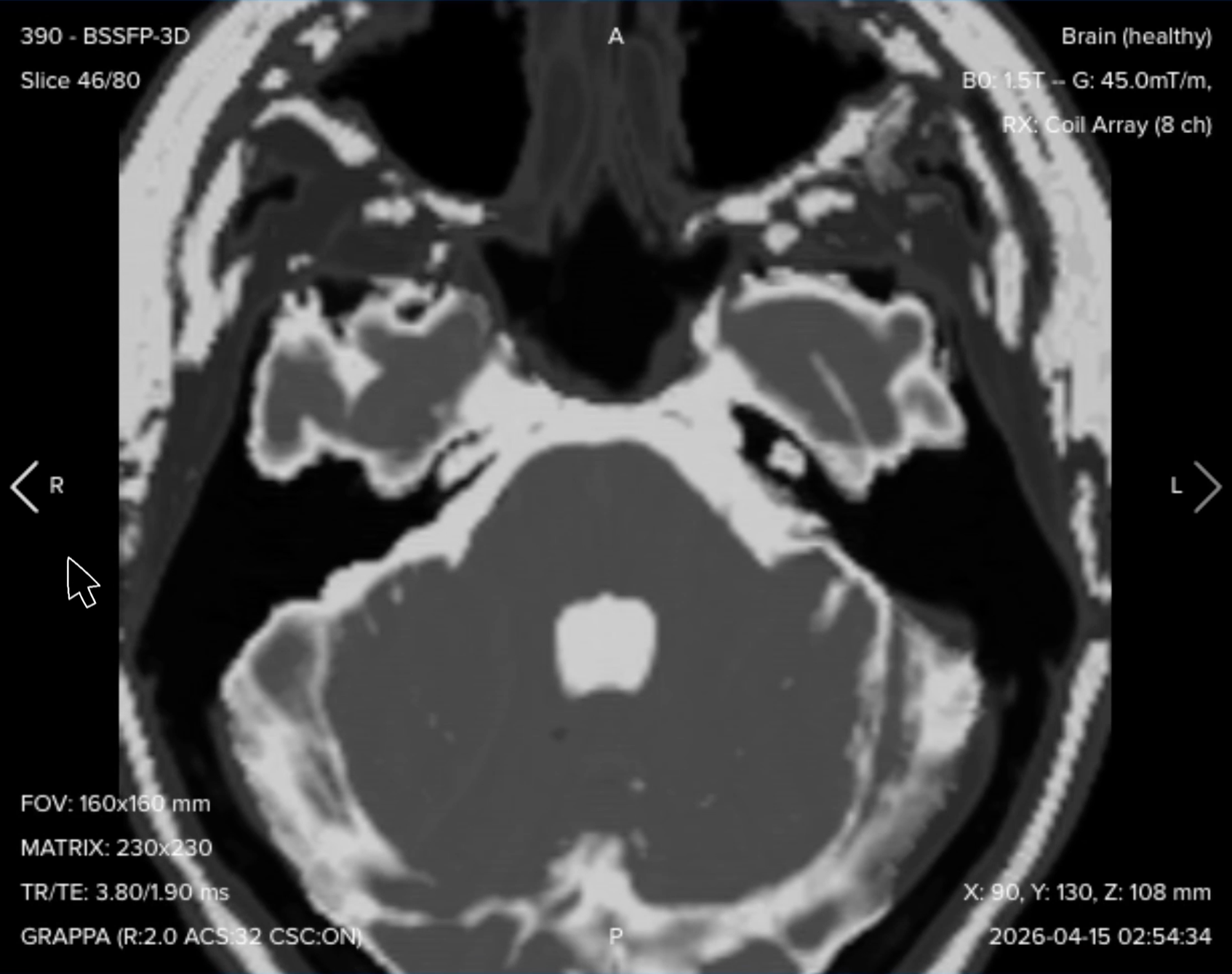 3D axial bSSFP (CISS/FIESTA-C) image showing cranial nerves VII and VIII as dark structures within bright cerebrospinal fluid
